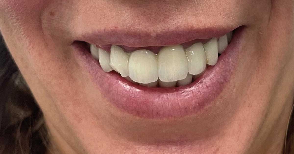 Sonrisa Gingival Gingival 2