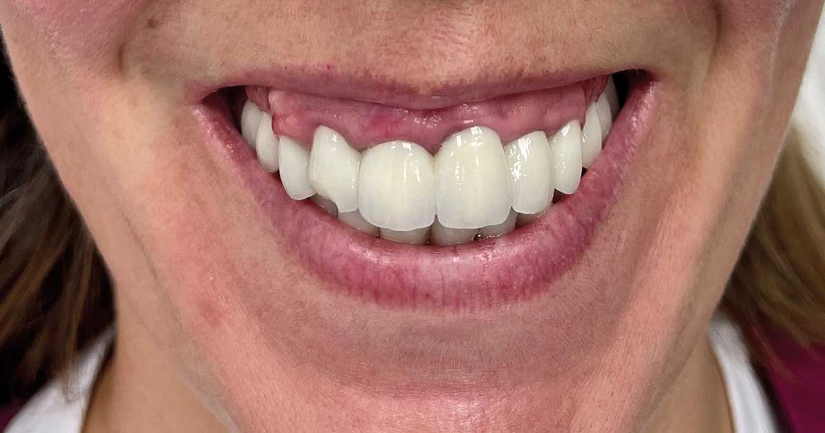 Sonrisa Gingival Gingival