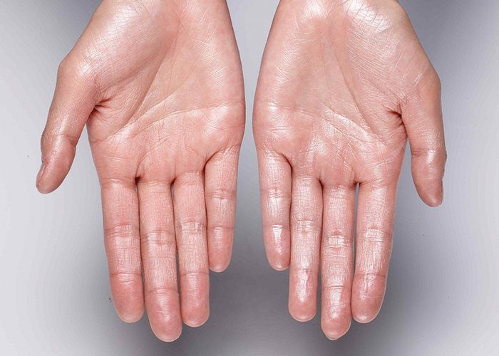 hiperhidrosis