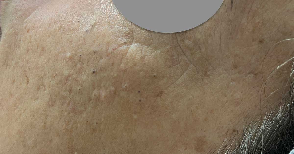 Hydrafacial Hydrafacial