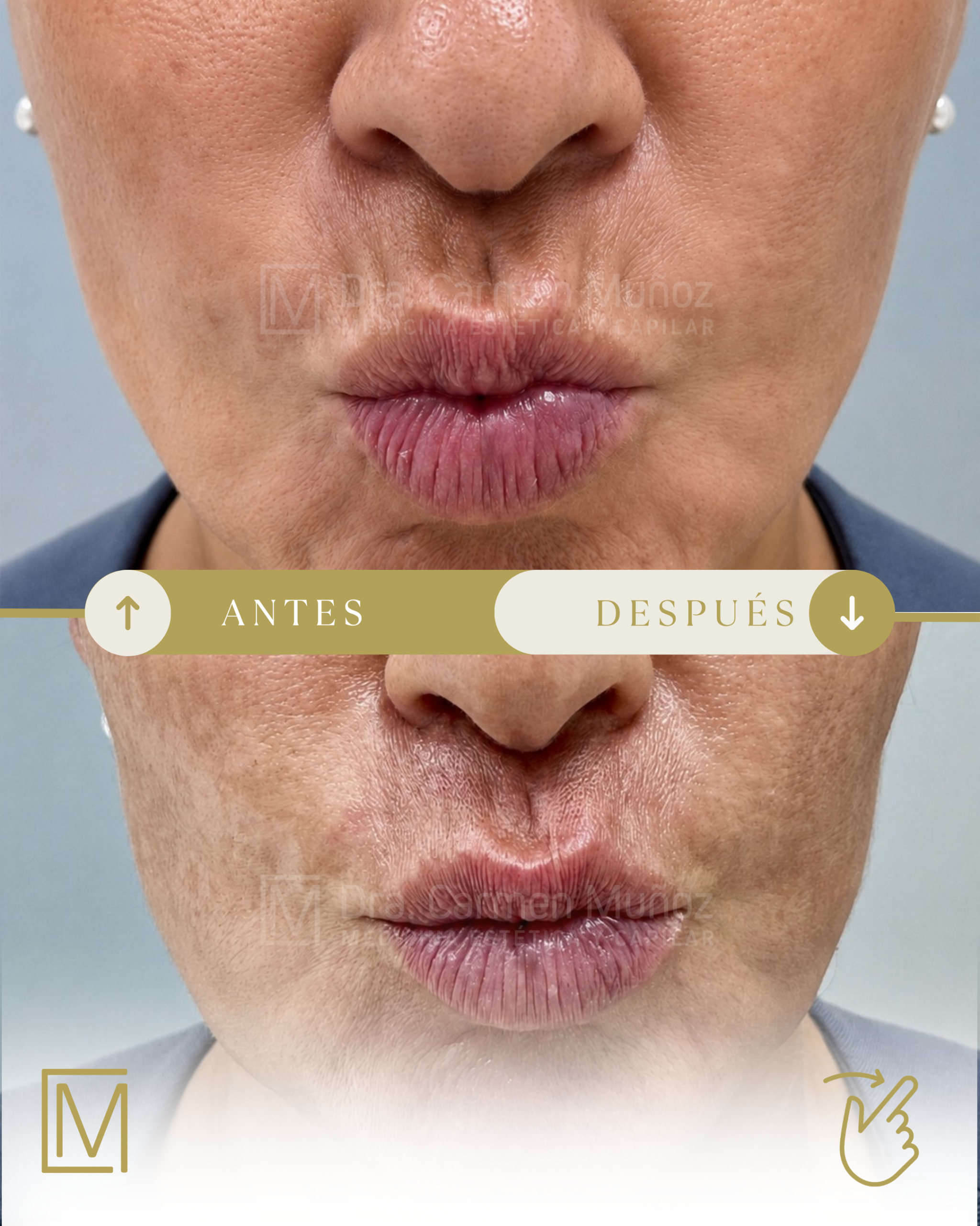 Antes y después de un tratamiento de arrugas periorales en la Clínica Dra. Carmen Muñoz
