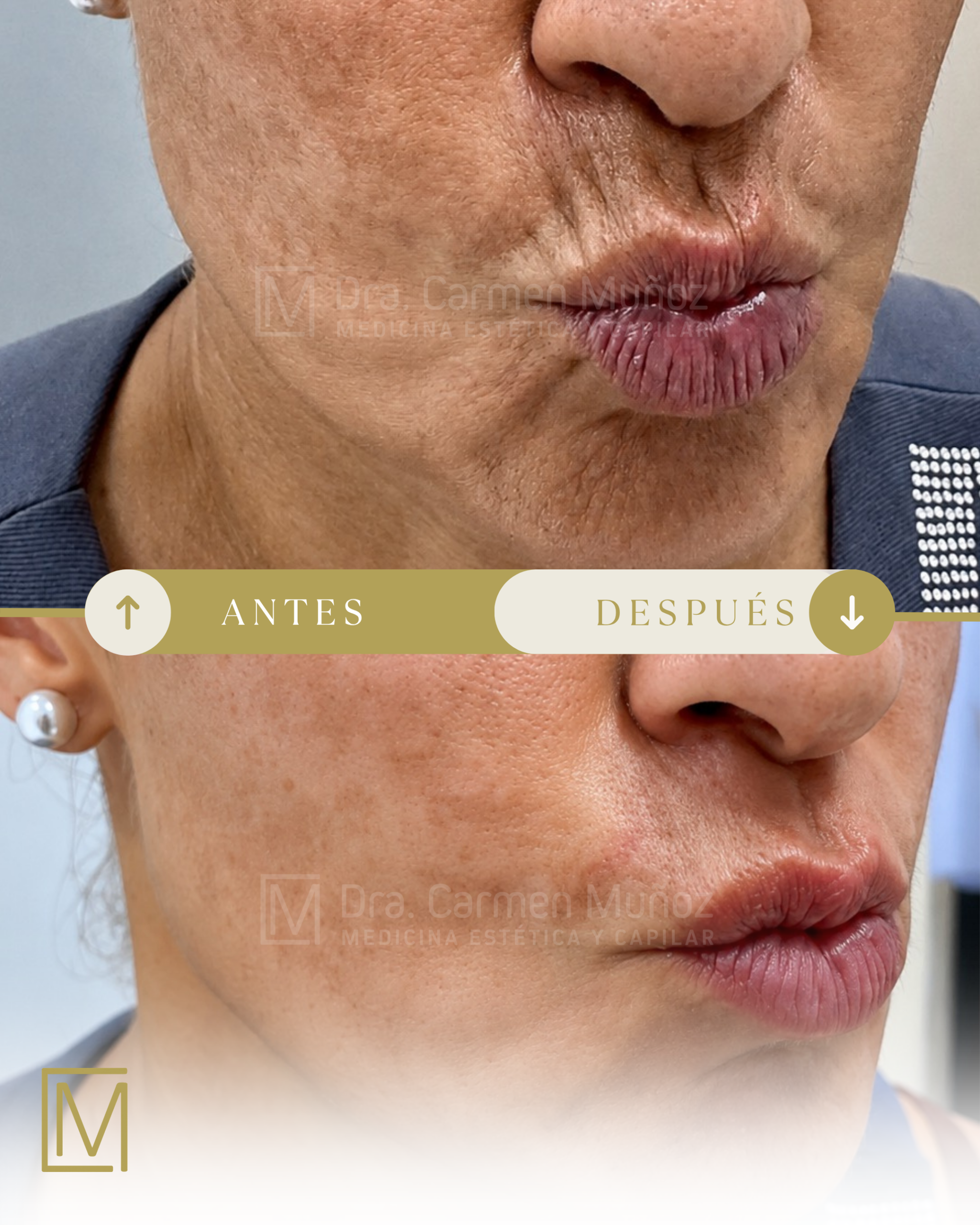 Segundo antes y después de un tratamiento de arrugas periorales en la Clínica Dra. Carmen Muñoz