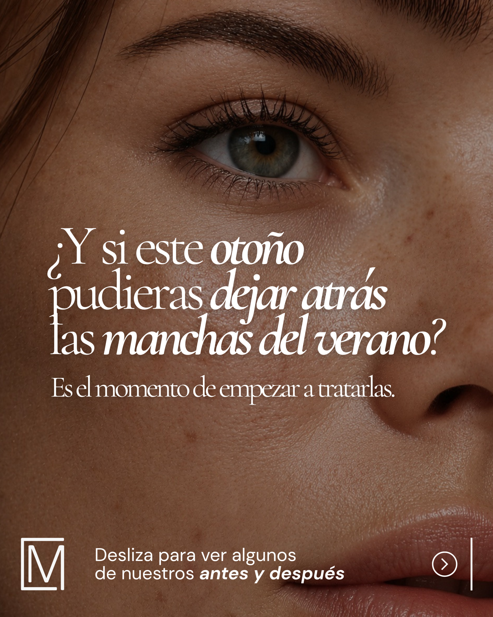 Evolución del tratamiento del melasma · imagen 1 de 5