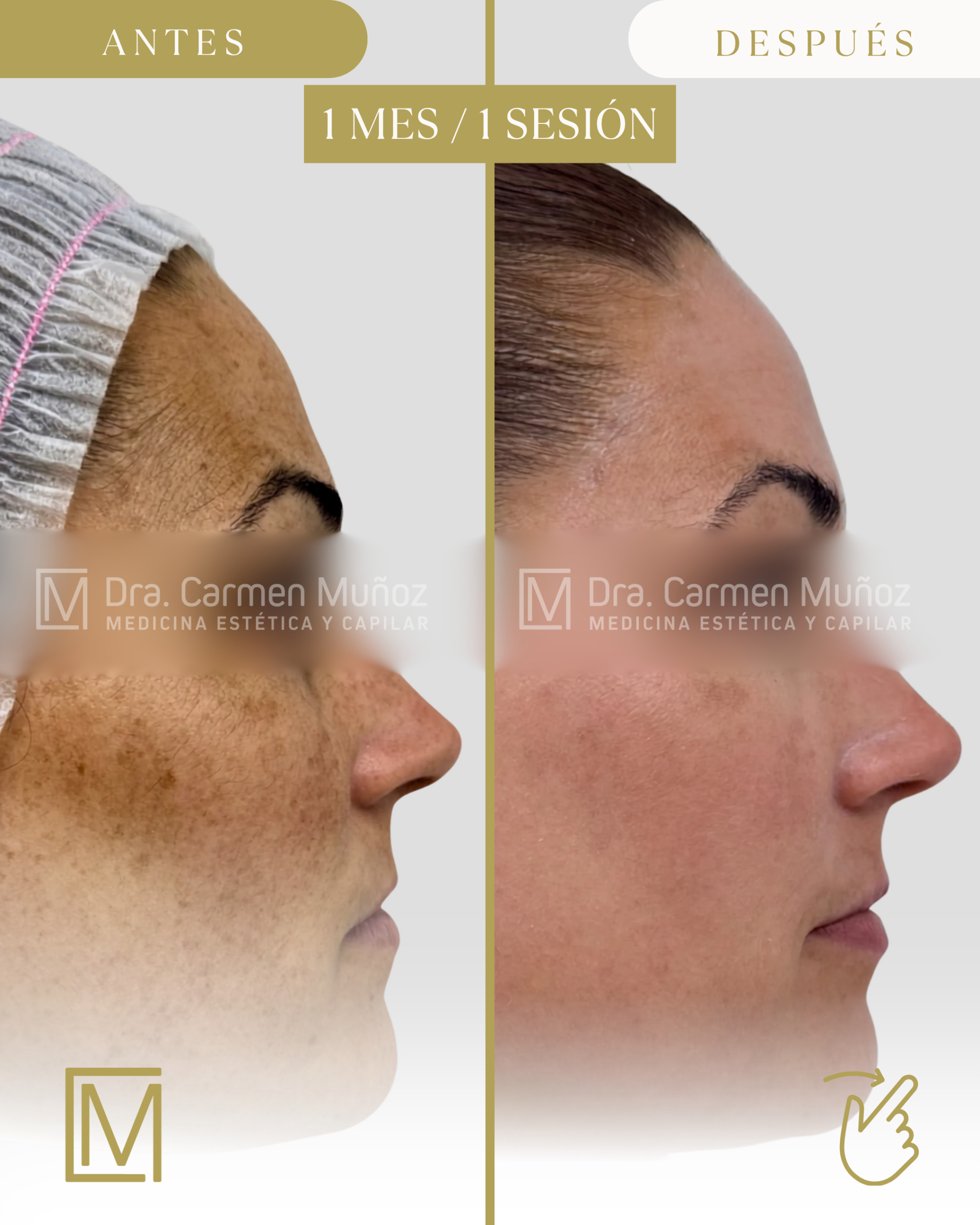 Evolución del tratamiento del melasma · imagen 2 de 5