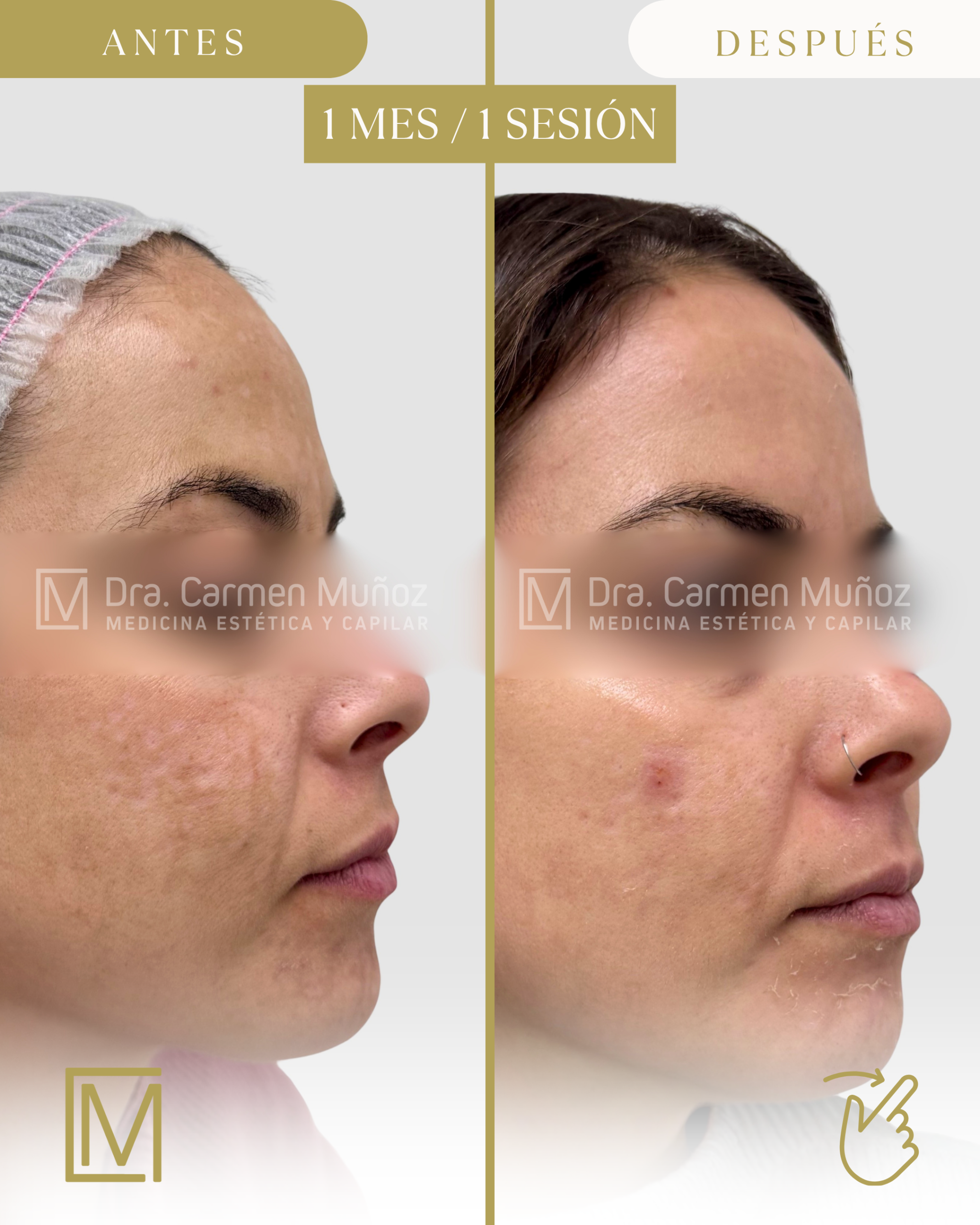 Evolución del tratamiento del melasma · imagen 3 de 5