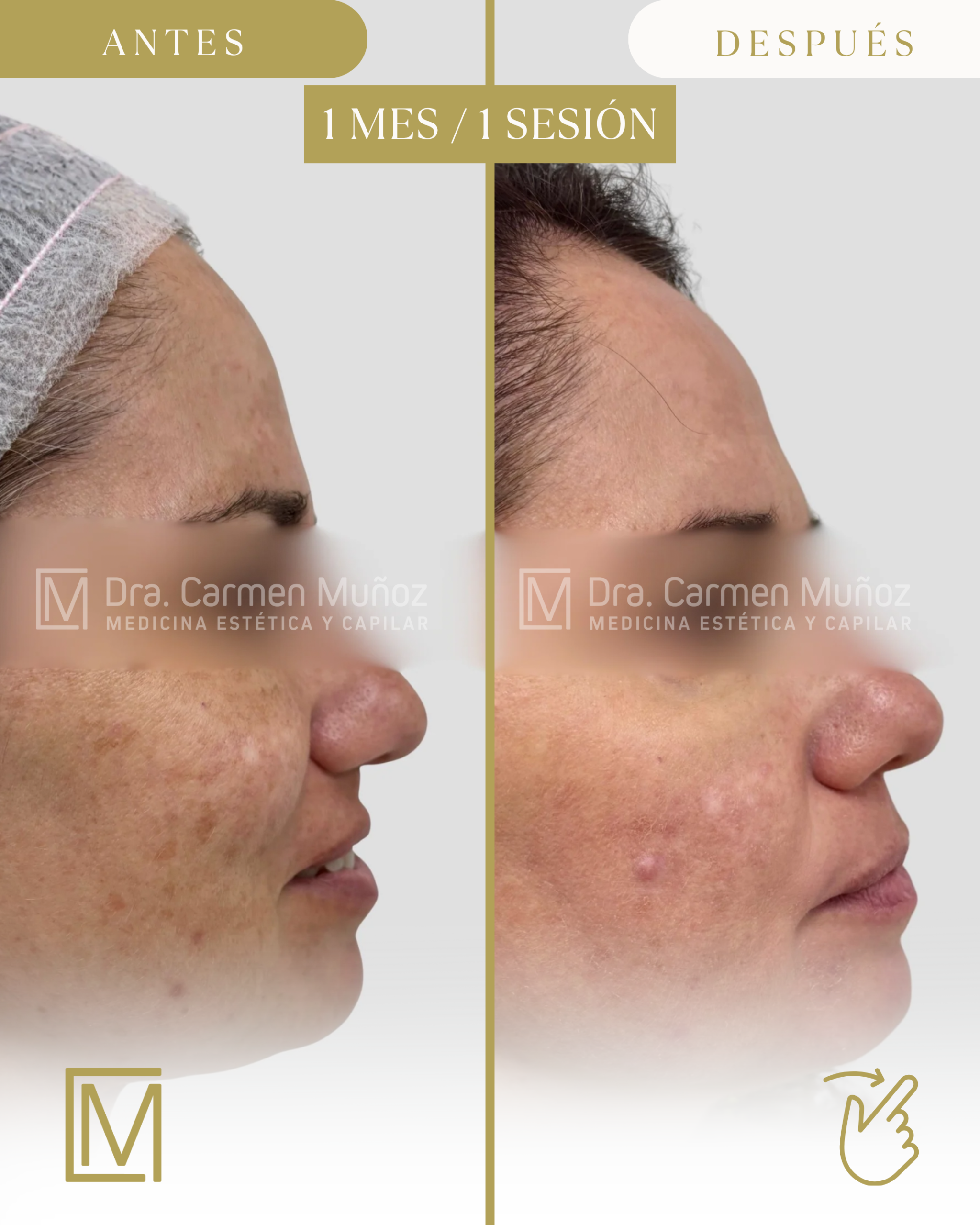 Evolución del tratamiento del melasma · imagen 4 de 5