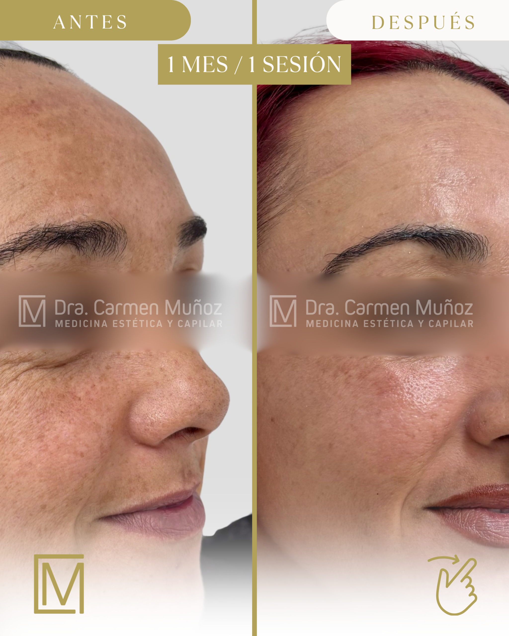 Evolución del tratamiento del melasma · imagen 5 de 5