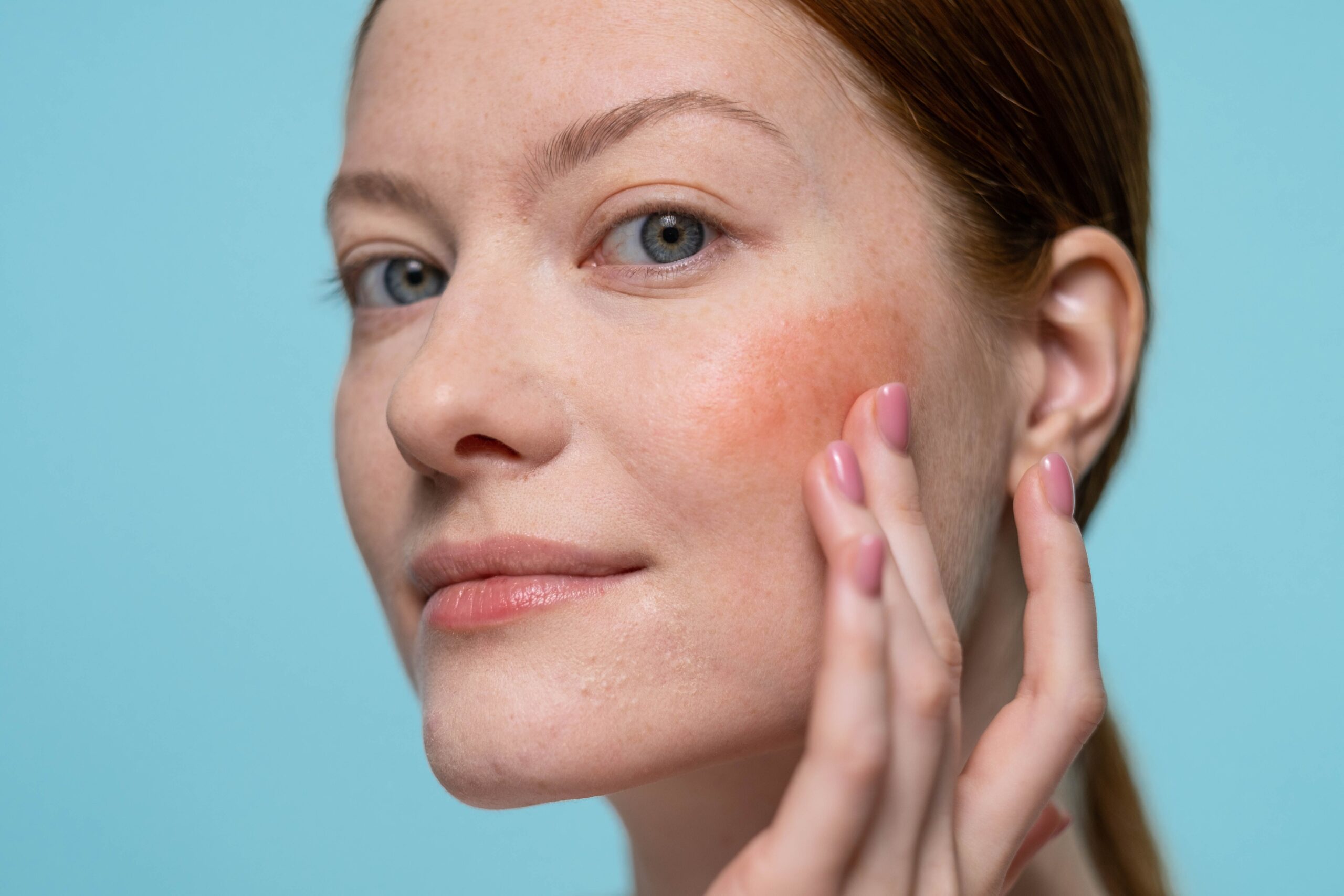 Tratamiento del melasma en la Clínica Dra. Carmen Muñoz en Algeciras
