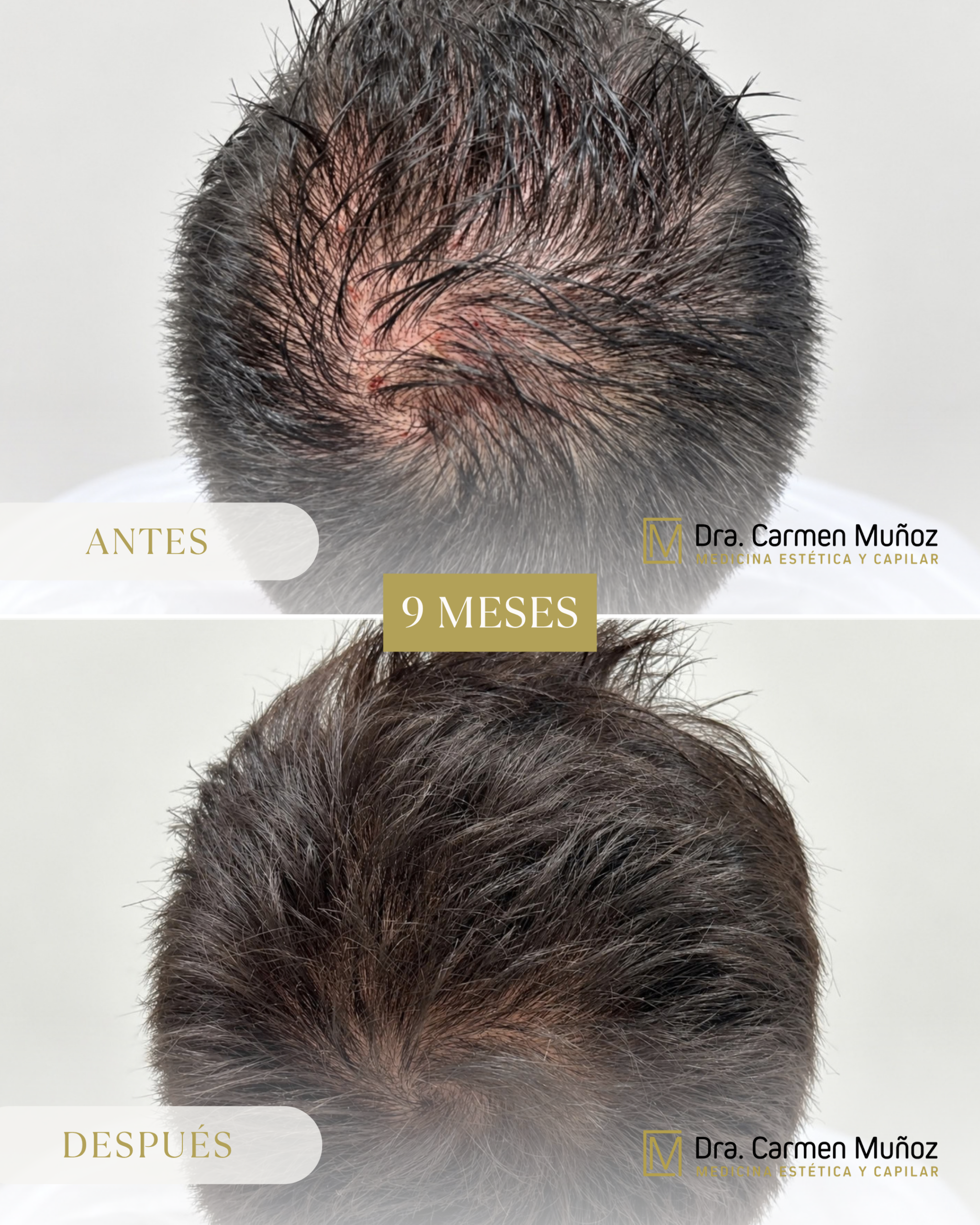 Antes y después de un tratamiento de alopecia en la Clínica Dra. Carmen Muñoz