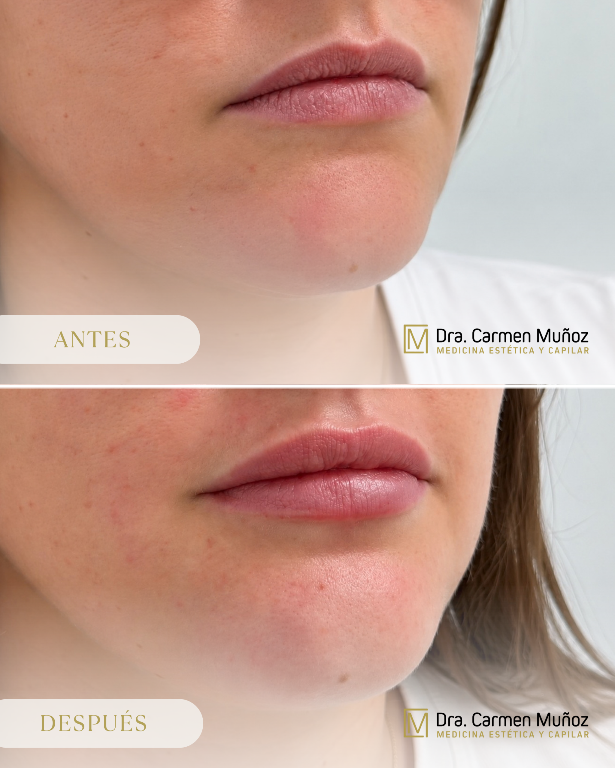 Antes y después de un tratamiento de labios en la Clínica Dra. Carmen Muñoz